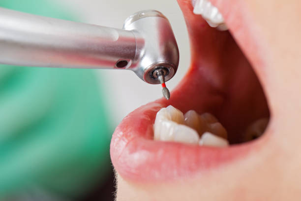 Best Chipped Tooth Repair Near Me  in Lifornia Polytechnic State University, CA